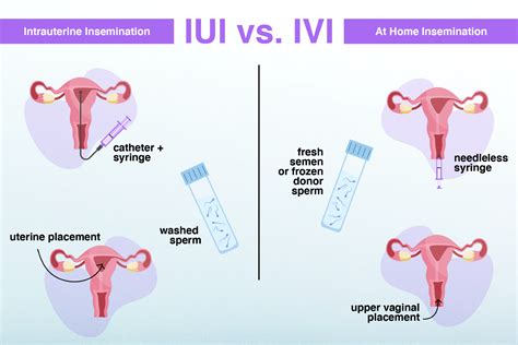 diagram postopka IUI