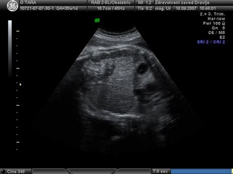 Grafikon normalnih vrednosti indeksa plodovnice (AFI) po tednih nosečnosti