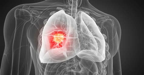Diagram razvoja pljuč pri nedonošenčku
