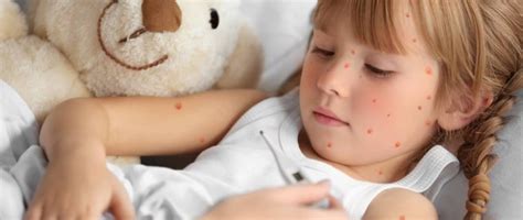 Otrok z izpuščaji zaradi noric