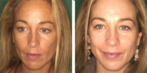 Pigmentne lise na obrazu v nosečnosti