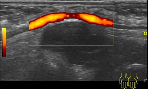 Ultrazvočni prikaz ciste na jajčniku
