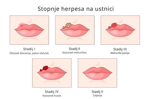Ilustracija izbruha herpesa na ustnici