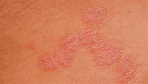 Ilustracija otroka z izpuščaji na obrazu, ki spominjajo na metuljčka