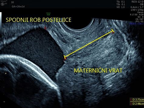 Ultrazvok trebušne prepone ploda
