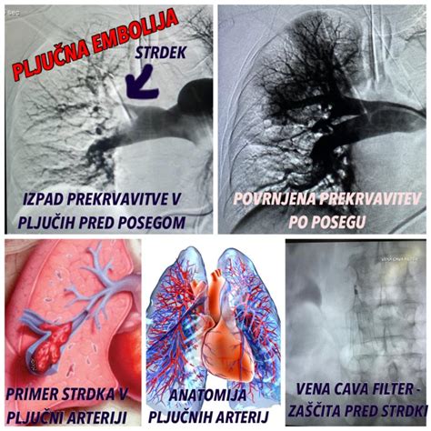 Diagram pljučnih arterij s prikazom embolije