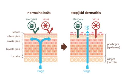 Diagram, ki prikazuje mehanizem delovanja monoklonskih protiteles pri atopijskem dermatitisu