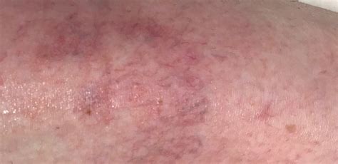 Pajkaste žilice na nogah