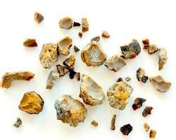 Primerjava različnih vrst bolečin: menstrualni krči, ledvični kamni, zlomi kosti, porod.