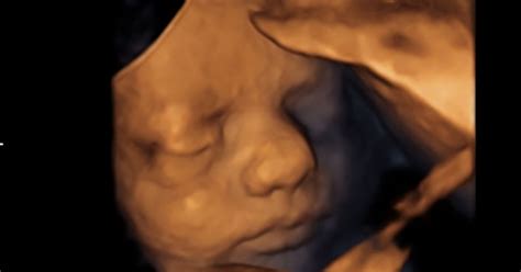 Ultrazvočni posnetek zarodka