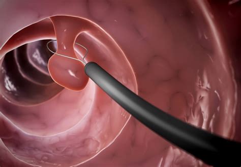 Endoskopski posnetek polipa v debelem črevesu