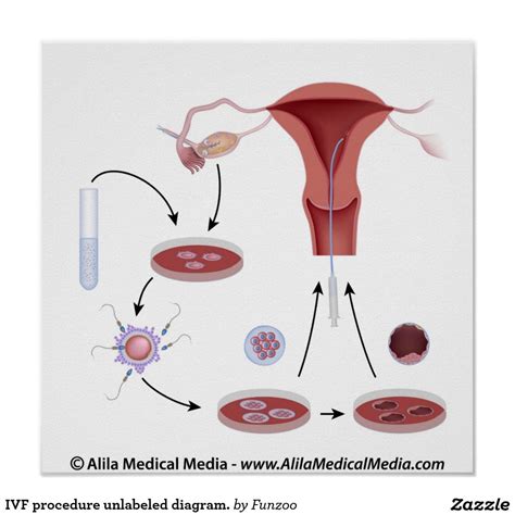 Diagram postopka IVF
