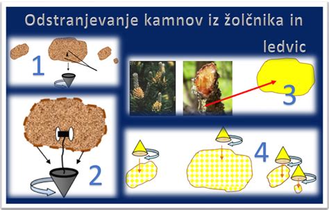 Vizualizacija nastajanja ledvičnih kamnov