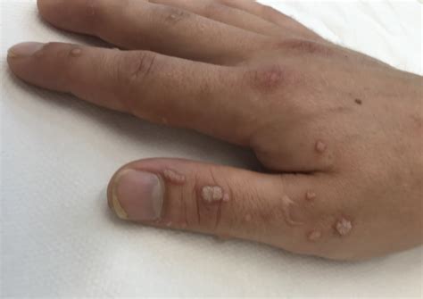 Prikaz glivične okužbe bradavice s poudarkom na rdečini in srbenju.