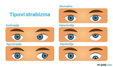 Diagram prikazuje različne vrste strabizma (ezotropija, eksotropija)