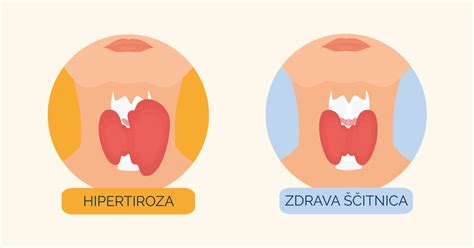 Simptomi hipotiroze in hipertiroze