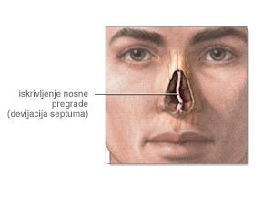 Simptomi deviacije nosnega pretina