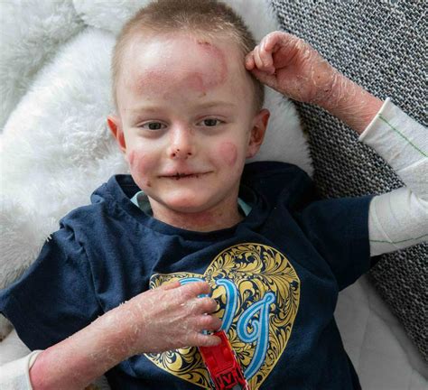 Otrok z ekcemom na obrazu