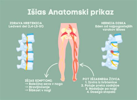 Prikaz poteka ishiadičnega živca