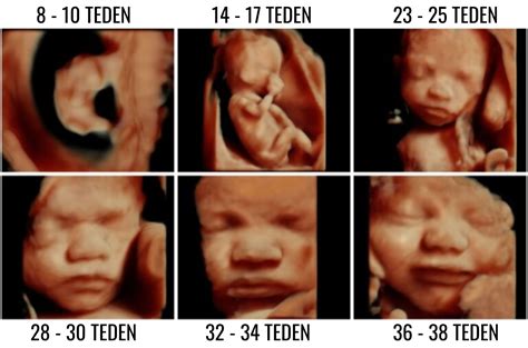 Ultrazvok ploda med 20. in 22. tednom nosečnosti