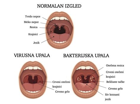 Simptomi bolečega grla