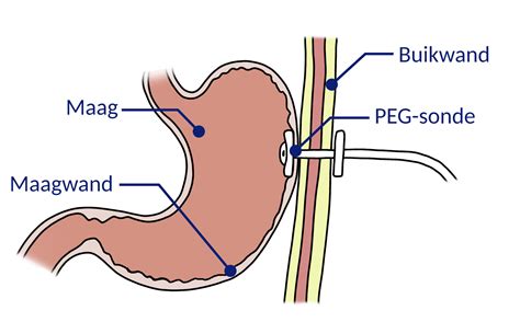 Diagram, ki prikazuje namestitev gastrostomske sonde (PEG)