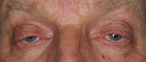 Ptoza veke, ki povzroča asimetrijo oči