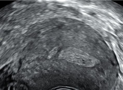 ultrazvok maternice po carskem rezu