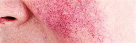 Otroška ritka z rdečico