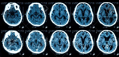 CT posnetek glave z jasno vidnim epiduralnim hematomom