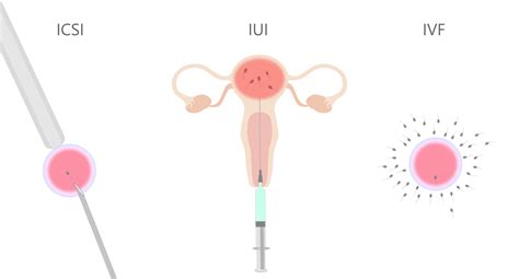 Diagram, ki primerja postopka IVF in IUI