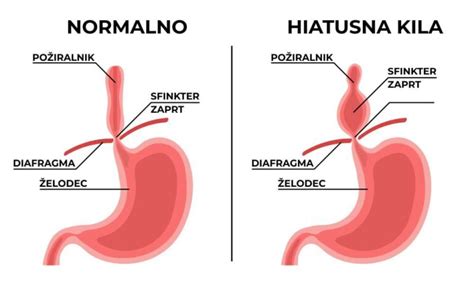 Grafični prikaz anatomije požiralnika in želodca z označenim spodnjim požiralnikovim sfinkterjem