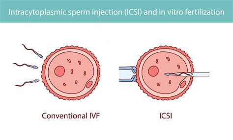 Diagram, ki prikazuje korake postopka IVF in ICSI