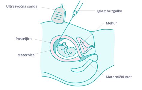 diagram postopka biopsije horionskih resic