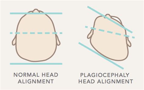 Diagram primerjava plagiocefalije in brahicefalije