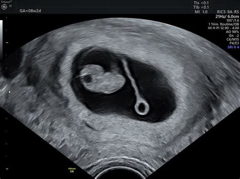 Ultrazvok ploda v 14. tednu nosečnosti