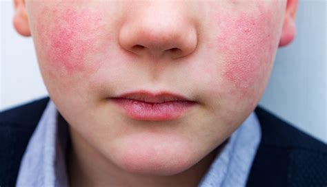 Simptomi pete bolezni