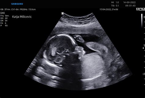 Ultrazvočni posnetek ploda v 33. tednu nosečnosti