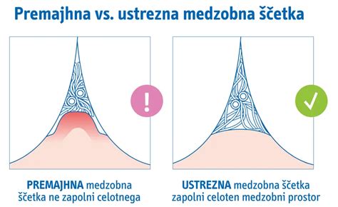 Ilustracija nosečniškega granuloma na dlesni