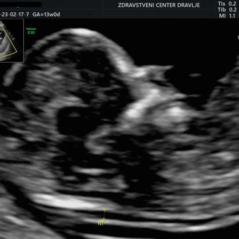 Ilustracija ženskih prsi z označenimi spremembami v nosečnosti