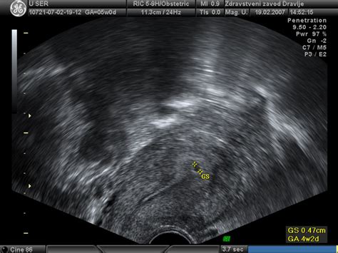 Ultrazvočni prikaz zgodnje nosečnosti z gestacijsko vrečko
