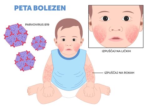 Ilustracija otroka z izpuščaji pete bolezni