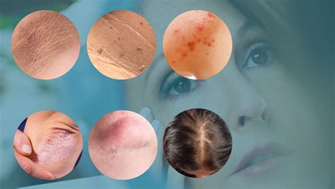 Prikaz impetiga na koži