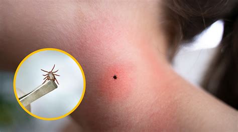 Prikaz pravilnega odstranjevanja klopa s pinceto