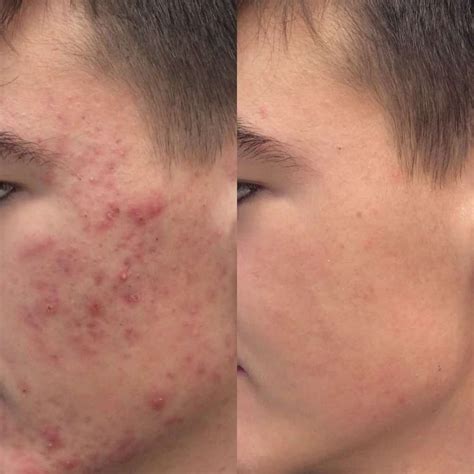 Primer brazgotine po carskem rezu pred in po negi