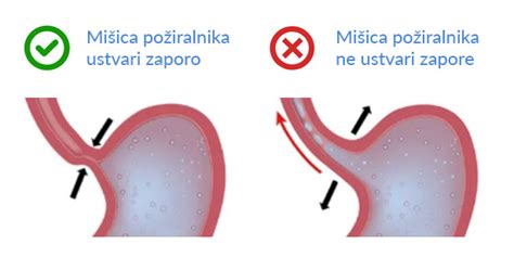Ilustracija pravilnega in nepravilnega pristavljanja otroka na dojko
