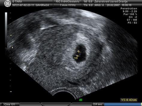 Ultrazvok ploda v 10. tednu nosečnosti