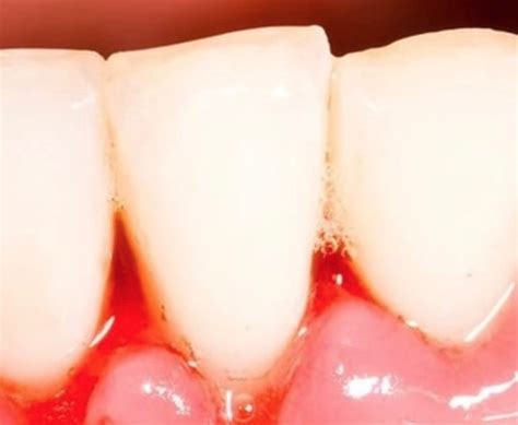 grafični prikaz razvoja parodontoze od gingivitisa do parodontitisa