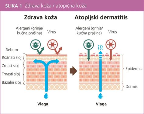 Infografika: Različne vrste dermatitisa pri dojenčkih