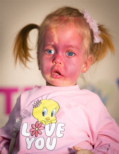 Novorojenček z rdečim ognjenim znamenjem na obrazu